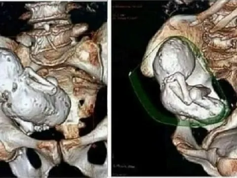 Đi khám vì đau bụng, cụ bà 73 tuổi bàng hoàng khi bác sĩ phát hiện thai nhi hóa đá suốt 30 năm