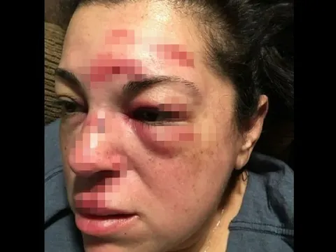 Vấp ngã, người phụ nữ nhận bồi thường hơn 300 tỷ đồng