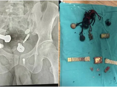 Đau bụng suốt nhiều ngày, người đàn ông bàng hoàng khi bác sĩ gắp ra... đồng hồ và nhiều dị vật khác