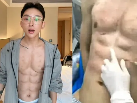 Nam thanh niên chi hơn 13 tỷ đồng tiêm hóa chất để có thân hình 8 múi mơ ước: Cái giá của vẻ đẹp nhân tạo