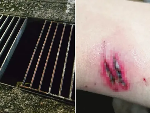 Lọt chân vào khe nắp cống, người phụ nữ bị thương nặng, nhưng phản hồi hời hợt của ban quản lý mới gây bức xúc