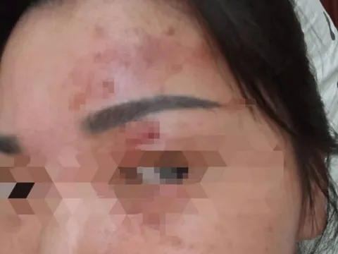 Bỏng giác mạc chỉ vì bất cẩn khi giặt đồ