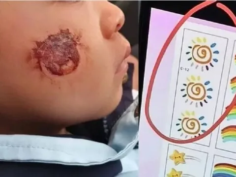 Dán sticker cho “đáng yêu hơn”, bé gái 3 tuổi nhập viện với tổn thương da nghiêm trọng, phụ huynh bàng hoàng