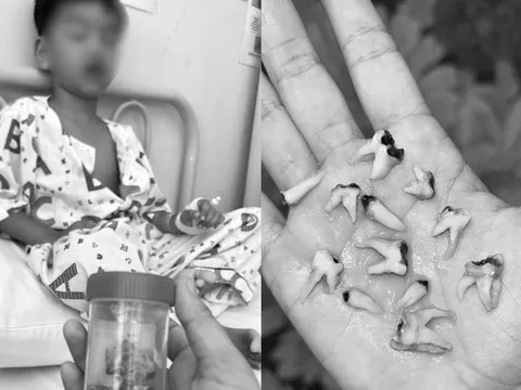 Bé trai phải nhổ 12 chiếc răng sâu cùng lúc chỉ vì thói quen này khiến nhiều cha mẹ giật mình