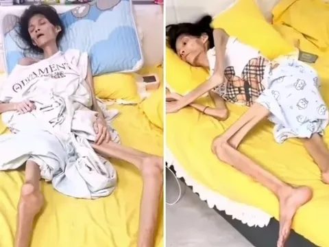 Trầm cảm kéo dài, người phụ nữ chỉ còn "da bọc xương" trước khi qua đời vì căn bệnh nguy hiểm này