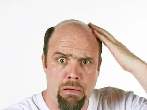 Vợ nộp đơn kiện cả nhà chồng vì... "hói đầu"