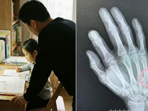 Kèm con học bài, cha nhập viện vì gãy tay sau cơn tức giận