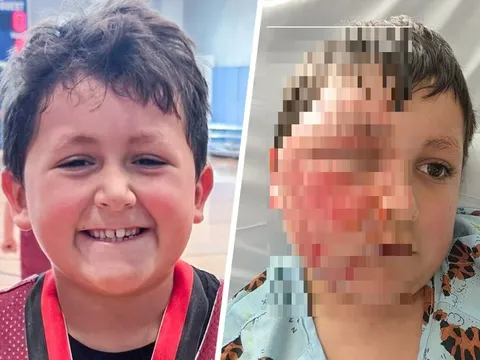 "Đu trend" Tiktok, bé trai 9 tuổi bị bỏng nặng