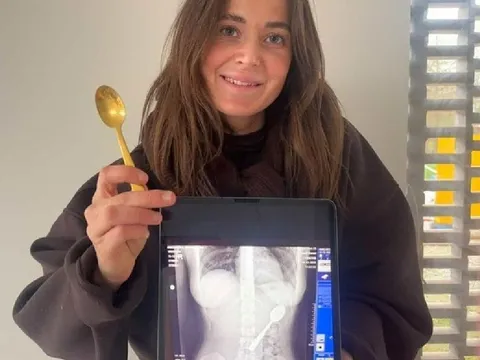 Đang ăn sữa chua, cô gái bất ngờ "nuốt trọn" chiếc thìa dài 17 cm