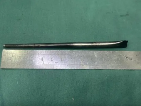 Nuốt phải đũa kim loại khi ăn, người đàn ông sống suốt 8 năm với dị vật trong cổ họng