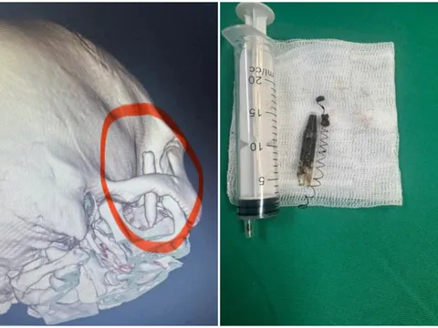 Người đàn ông mang lò xo bút bi suốt 13 năm trong vùng thái dương mà không hay biết