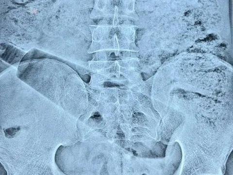 Đau bụng suốt 36 tiếng không rõ nguyên nhân, người đàn ông nhập viện và phát hiện điều khiến nhiều người bất ngờ