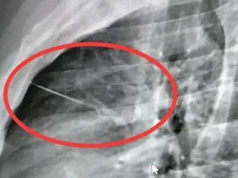 Tưởng chỉ là cơn đau ngực bình thường, người đàn ông sốc khi biết có dị vật nằm sát tim: Bác sĩ phải phẫu thuật khẩn cấp