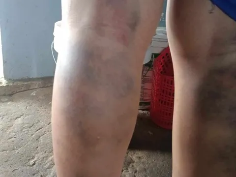 Đình chỉ công tác cô giáo đánh bầm tím chân học sinh lớp 6