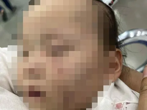 Vụ bé gái 1 tuổi có nhiều vết bầm trên mặt khi gửi ở cơ sở mầm non: Trên má có dấu hiệu vết răng cắn
