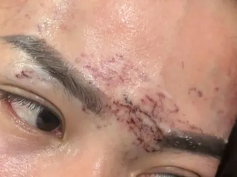 Ghen tuông kiểu “xã hội đen”: Hai phụ nữ xăm lên mặt tình địch và cái kết