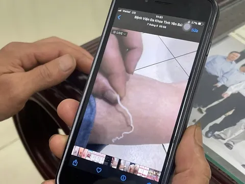 Rùng mình: Người đàn ông nặn mủ chân, kéo ra con giun dài 70cm dưới da