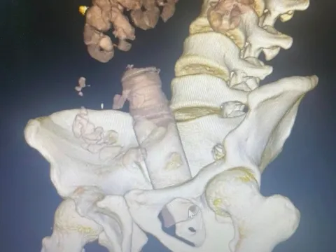 Cái kết đắng cho nam thanh niên tự chế đồ chơi tình dục để sử dụng