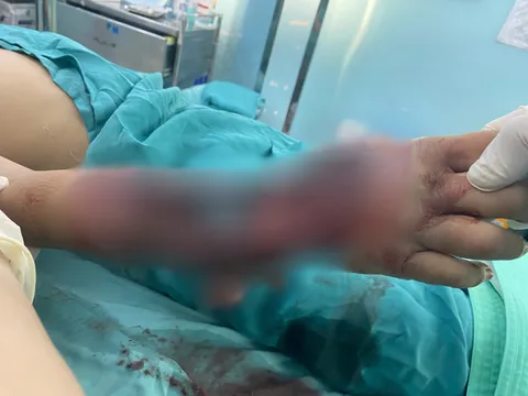 Hình ảnh kinh hoàng: Bé 10 tuổi bị tường đổ sập đè trúng, cánh tay biến dạng nghiêm trọng