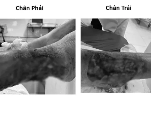 Hình ảnh lạnh gáy: Đôi chân có nguy cơ hoại tử ở bệnh nhân đái tháo đường sau chấn thương nhỏ