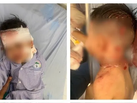 Xót xa bé trai 3 tuổi bị chó nhà hàng xóm cắn lộ xương sọ, đứt tĩnh mạch