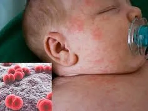 Cảnh báo viêm màng não mô cầu: Trẻ có thể tử vong sau 24 giờ nếu không phát hiện sớm