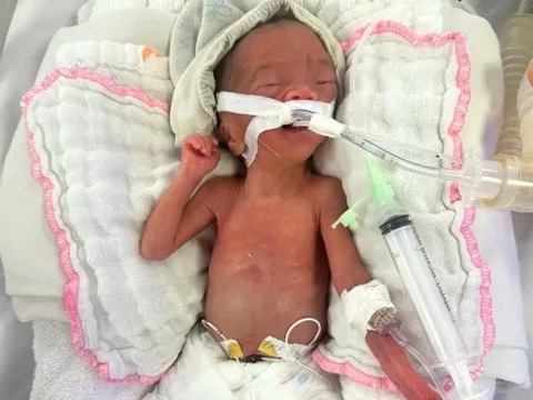 Bé gái từng nặng 550g được cứu sống thần kỳ: Hình ảnh hiện tại khiến ai cũng nghẹn ngào