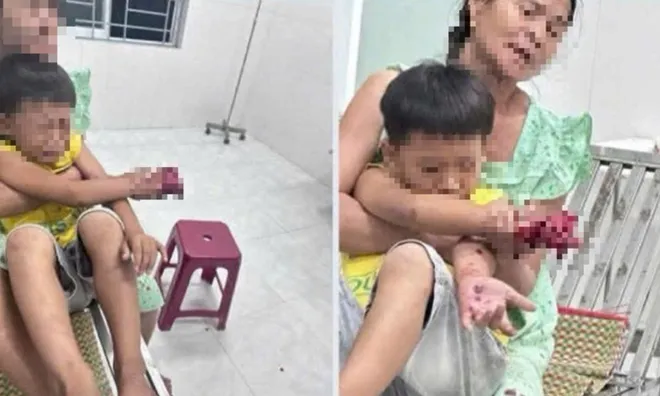 Tiếng la hét và bàn tay phải bị dập của cháu bé 9 tuổi, nghi do điện thoại phát nổ