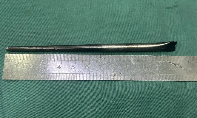Suốt 8 năm chịu đựng cảm giác vướng víu trong cổ, người đàn ông đi khám mới giật mình phát hiện ra vật đáng sợ này
