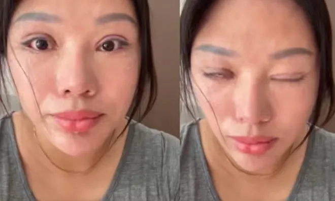 Tin lời “giám đốc thẩm mỹ”, cô gái sống 6 năm không thể nhắm mắt sau ca cắt mí hỏng
