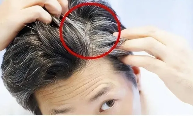 Tóc trắng mọc trên trán, thái dương và sau đầu cảnh báo điều gì? 7 việc cần làm để tóc luôn đen nhánh