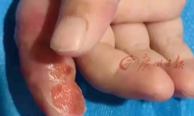 Sơ suất khi cai mút tay, bé 11 tháng suýt cụt ngón vì mẹ làm theo mẹo dân gian