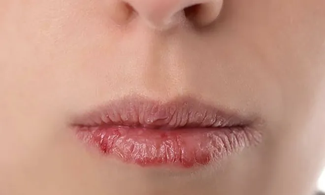Muốn có một đôi môi hồng hào, căng mọng bạn hãy dừng lại ngay những thói quen này