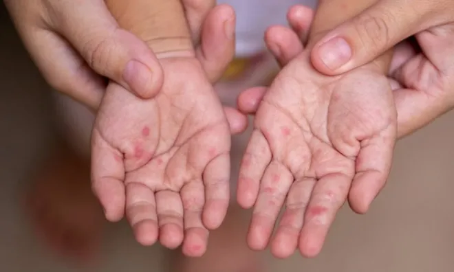 Hà Nội cảnh báo "nóng" sau ca tử vong đầu tiên do sởi