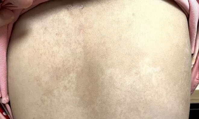 Con gái 5 tuổi có nhiều đốm nâu trên lưng, mẹ tưởng là tàn nhang nhưng đến bệnh viện bác sĩ đưa ra kết luận sốc