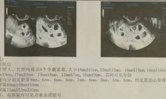 Đến bệnh viện chữa hiếm muộn, cô gái 25 tuổi sốc nặng khi nghe bác sĩ kết luận: Đang mang thai 9 con