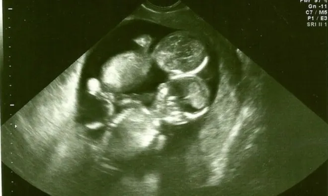 Cặp sinh đôi mắc bệnh hiếm, hai dây rốn đan nhau như tết tóc vẫn sống sót kỳ diệu, chào đời cực xinh