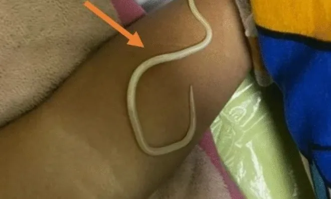 Bé trai 3 tuổi nôn ra hàng trăm con giun sống, bác sĩ cảnh báo thói quen nguy hiểm này