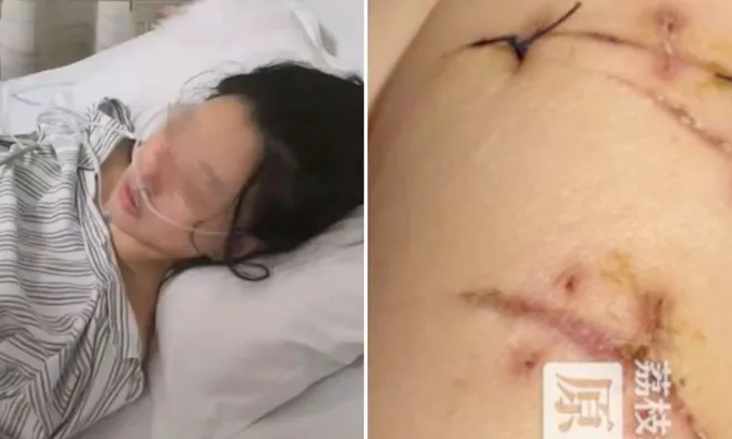 Thoát chết kỳ diệu nhờ... ngực giả