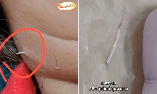 Cảnh báo sau vụ xương cá đâm xuyên cổ: Đừng cố nuốt thêm cơm khi hóc xương