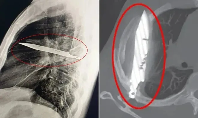 Người đàn ông sống sót kỳ diệu với lưỡi dao cắm trong ngực suốt 8 năm mà không hề hay biết