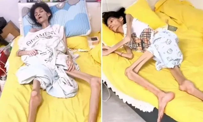 Trầm cảm kéo dài, người phụ nữ chỉ còn "da bọc xương" trước khi qua đời vì căn bệnh nguy hiểm này