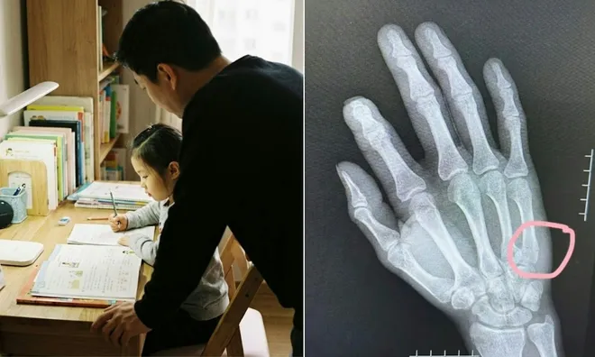 Kèm con học bài, cha nhập viện vì gãy tay sau cơn tức giận