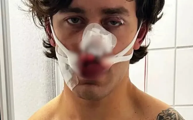 Mỹ nam 21 tuổi xông vào bảo vệ hai cô gái, khuôn mặt điển trai tan tành sau nhát dao trên tàu điện