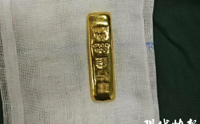 Bé trai 11 tuổi phải nhập viện sau khi nuốt nguyên thỏi vàng