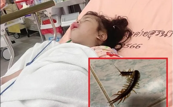 Bị rết cắn vào miệng khi ngủ, bé gái 3 tuổi phải nhập viện khẩn cấp