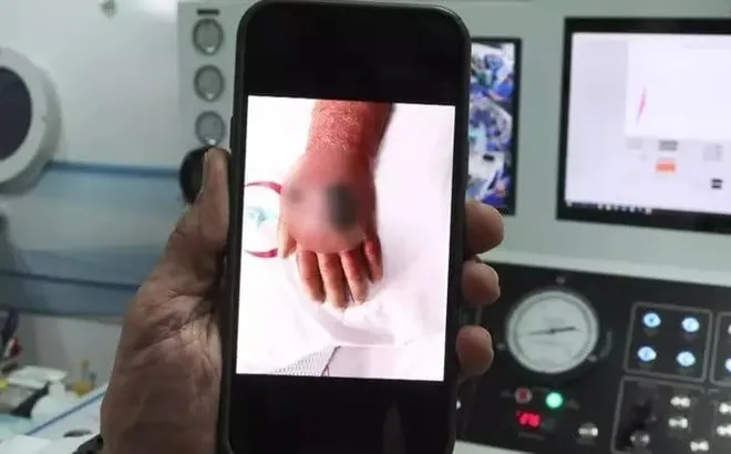 Chủ cửa hàng 60 tuổi bị cướp... cắn, suýt mất cả cánh tay vì nhiễm trùng nguy hiểm