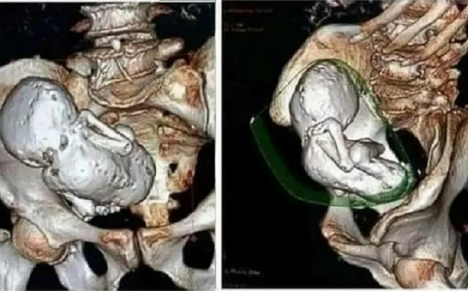 Đi khám vì đau bụng, cụ bà 73 tuổi bàng hoàng khi bác sĩ phát hiện thai nhi hóa đá suốt 30 năm