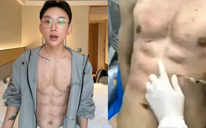 Nam thanh niên chi hơn 13 tỷ đồng tiêm hóa chất để có thân hình 8 múi mơ ước: Cái giá của vẻ đẹp nhân tạo