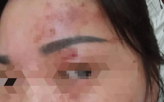 Bỏng giác mạc chỉ vì bất cẩn khi giặt đồ